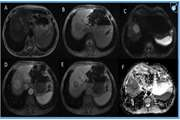 Assessment of LI RADS efficacy in classification of hepatocellular carcinoma and benign liver nodules using DCE MRI features and machine learning