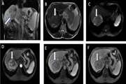 Comparing Texture Analysis of Apparent Diffusion Coefficient MRI in Hepatocellular Adenoma and Hepatocellular Carcinoma