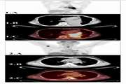 The Role of 1H MRS and [ 18F]FDG PET/CT in differentiating primary squamous cell carcinoma and metastatic Hodgkin’s lymphoma in lung: An experimental pilot study