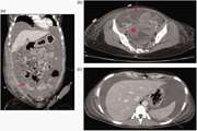 Spontaneous ovarian hyperstimulation syndrome mimicking ovarian cancer in a nonpregnant woman: A case report and literature review