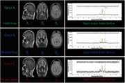 Neurochemical Alterations Linked to Persistent COVID 19 Induced Anosmia: Probing Into Orbitofrontal Cortex by Magnetic Resonance Spectroscopy