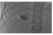 Percutaneous Sclerotherapy with Bleomycin and Ethiodized Oil: Is It a Promising Treatment for Giant Liver Hemangioma?