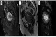 Diagnostic value of T2 and diffusion-weighted imaging (DWI) in local staging of endometrial cancer