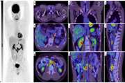 Nuclear medicine imaging in non-seminomatous germ cell tumors: lessons learned from the past failures