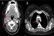 Vanishing bile duct syndrome related jaundice as the first presentation of Hodgkin lymphoma