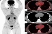 Exploring the latest advances in 18 F-FDG PET/CT and cardiac magnetic resonance for imaging for cardiac sarcoidosis diagnosis