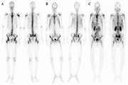 Superscan Pattern on Bone Scintigraphy: A Comprehensive Review