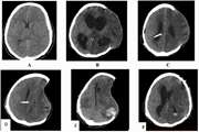 Paradoxical brain herniation following decompressive craniectomy: A case series and systematic review of literature
