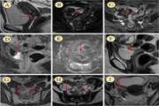 Imaging the post treatment pelvis with gynecologic cancers