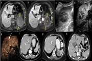 Differentiating malignant from benign splenic lesions: a meta analysis and pictorial review of imaging features