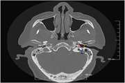 Determination of the radioanatomical factors related to the position of facial nerve in accessing jugular foramen and carotid artery in temporal bone