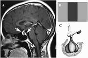 Vertical triband flag sign for differential diagnosis of Rathke’s cleft cyst