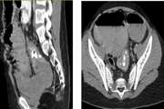 Pediatric Inflammatory Myofibroblastic Tumor of Rectosigmoid Junction: A Case Report and Review of the Literature