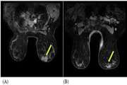 contras enhanced magnetic resonance imaging (DCE MRI) in the prediction of neoadjuvant chemotherapy response in breast cancer: A Meta Analysis