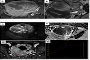 Modified MR scoring system for assessment of sonographically indeterminate ovarian and adnexal masses in the absence of dynamic contrast enhanced