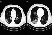 Correlation of clinical, laboratory, and short term outcomes of immunocompromised and immunocompetent COVID 19 patients with semi quantitative chest CT score findings: A case control study