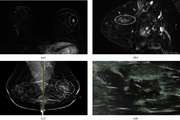 Evaluation of Features in Probably Benign and Malignant Nonmass Enhancement in Breast MRI