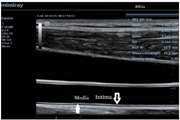 Effects of Idiopathic Restless Leg Syndrome on Intima Media Thickness of Carotid Artery: A Case Control Study