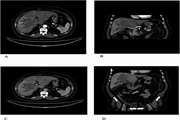 Benign hepatic schwannoma in a patient with chronic hepatitis B infection: A case report