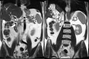 Liver hydatidosis disease with portal vein invasion: Report of a rare case and review of literature