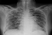 Accuracy of Chest Xray in Hospitalized COVID 19 Patients