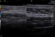 Sonographic skin features and shear wave elastography in distinguishing active from inactive morphea lesions: A case control study