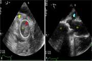 Devastating fungal endocarditis involving ascending aorta in a patient with a history of aortic valve replacement: a case report