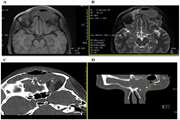 Functional Endoscopic Sinus Surgery in Management of Pott’s Puffy Tumor in a Pregnant Woman: A Clinical Case Report and Literature Review