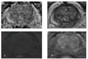 The Diagnostic Value of Multiparametric MRI in Locating Prostate Cancer in Comparison with Transrectal Ultrasound Guided Biopsy