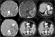 Diagnostic performance of different imaging modalities for splenic malignancies: A comparative meta analysis