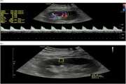 Combination of Doppler US and US Elastography is Superior to Doppler US or US Elastography Alone in Detecting Delayed Kidney Graft Rejection
