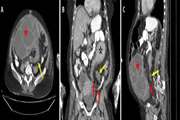 Sigmoid volvulus in a postmenopausal woman with ovarian cyst torsion: A rare case report with review of literature