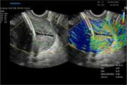 Diagnostic and clinical utility of ultrasound elastography for uterine cervical neoplasm