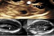 Fetal intracranial hemorrhage and infarct: Main sonographic and MRI characteristics: A review article