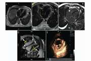 Diagnostic Efficacy of Magnetic Resonance Imaging and Echocardiography in Diagnosis of Constrictive Pericarditis