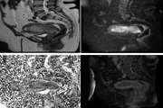 MRI Prediction Model for Anatomical Site Identification in Uterine Carcinoma: Enhancing Diagnostic Accuracy and Treatment Planning