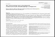 An interesting case of polypoid endometriosis: Challenging in diagnosis