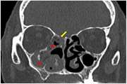 Computed Tomography Findings in Pathology-Confirmed Rhino-Orbital Mucormycosis During the COVID-19 Era: A Retrospective Cross-Sectional Study