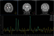 Impact of stem cell therapy on brain metabolic profile in cerebral palsy assessed by magnetic resonance spectroscopy in a randomized clinical trial