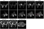 Differentiating malignant from benign breast masses: a multiparametric magnetic resonance imaging (MRI)-based radiomics approach with machine learning