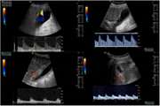 Diagnostic value of cystic artery colour Doppler ultrasound indices in acute cholecystitis