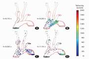 Patient-Specific Hemodynamic Simulation for Predicting Stroke Laterality in Cardiac Embolism
