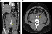 Fatal Spontaneous Retroperitoneal Hematoma Following Intense Physical Exertion in a Young Healthy Male: A Case Report