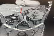 Complicated IVC Filter Placement in a Patient With Venous Abnormality: A Case Report