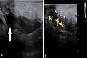 Ultrasound findings in the early diagnosis of idiopathic granulomatous mastitis: a large-scale study