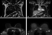 Comparative Analysis of Abbreviated and Full Protocol MRI in Detecting Axillary Lymph Node Metastasis in Patients with Known Breast Cancer