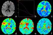 Diagnostic value  of Intra Voxel Incoherent Motion images using MRI based on deep learning analysis to predict glioma genotype