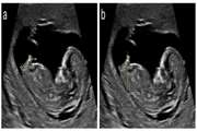 The diagnostic value of the sacrovesical distance in ultrasound to predict the gender of the fetus in the second trimester of pregnancy