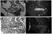 MRI Prediction Model for Anatomical Site Identification in Uterine Carcinoma: Enhancing Diagnostic Accuracy and Treatment Planning