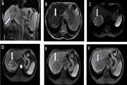 Comparing Texture Analysis of Apparent Diffusion Coefficient MRI in Hepatocellular Adenoma and Hepatocellular Carcinoma